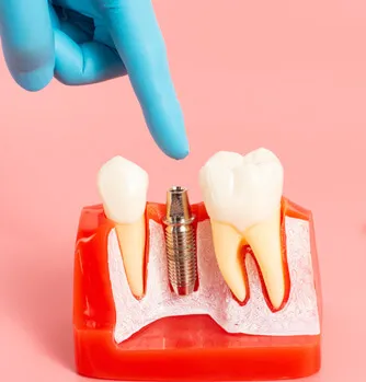 Astra Tech Implants